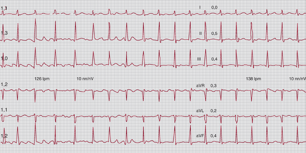 Electrocardiogramas