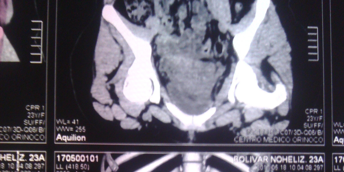 Tomografia Helicoidal